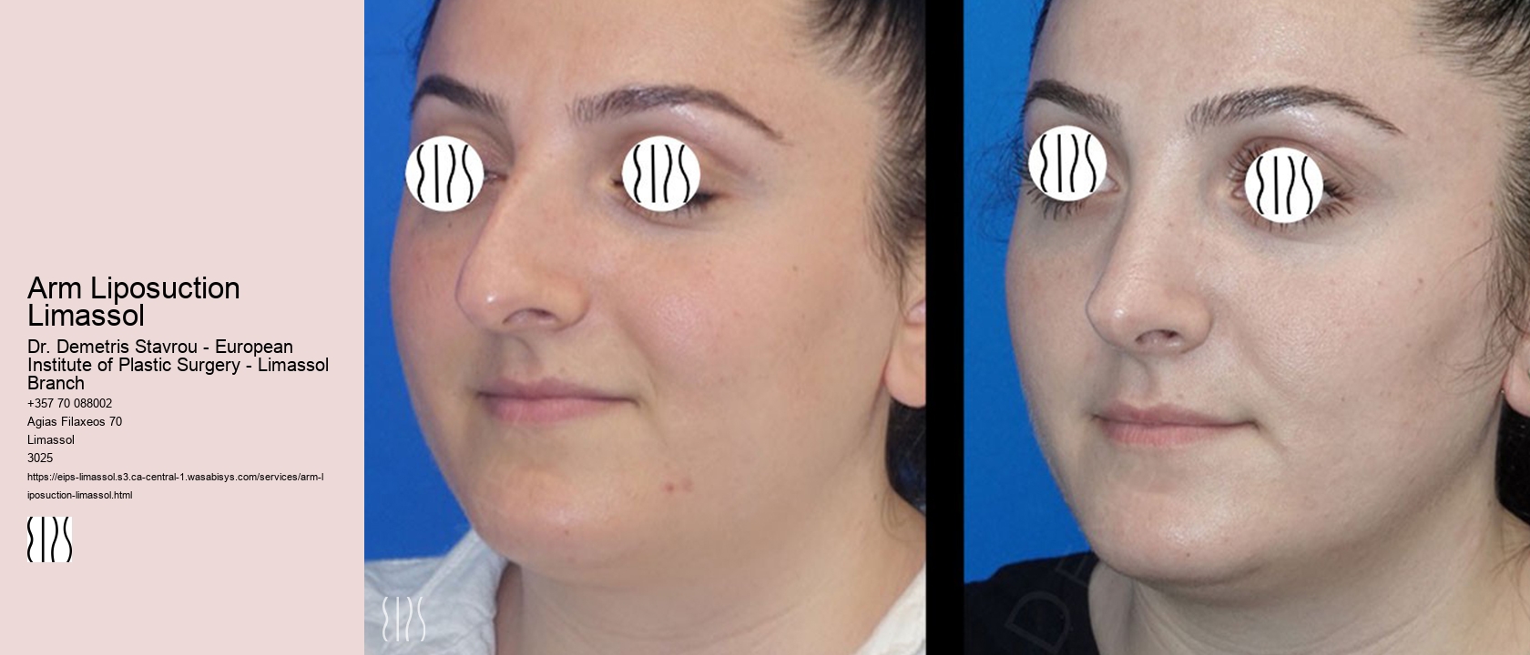 Arm Liposuction Limassol