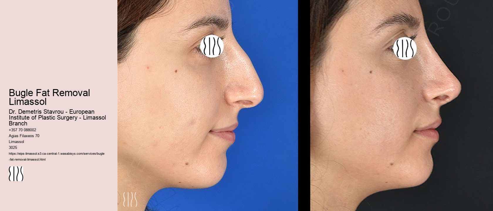 Bugle Fat Removal Limassol