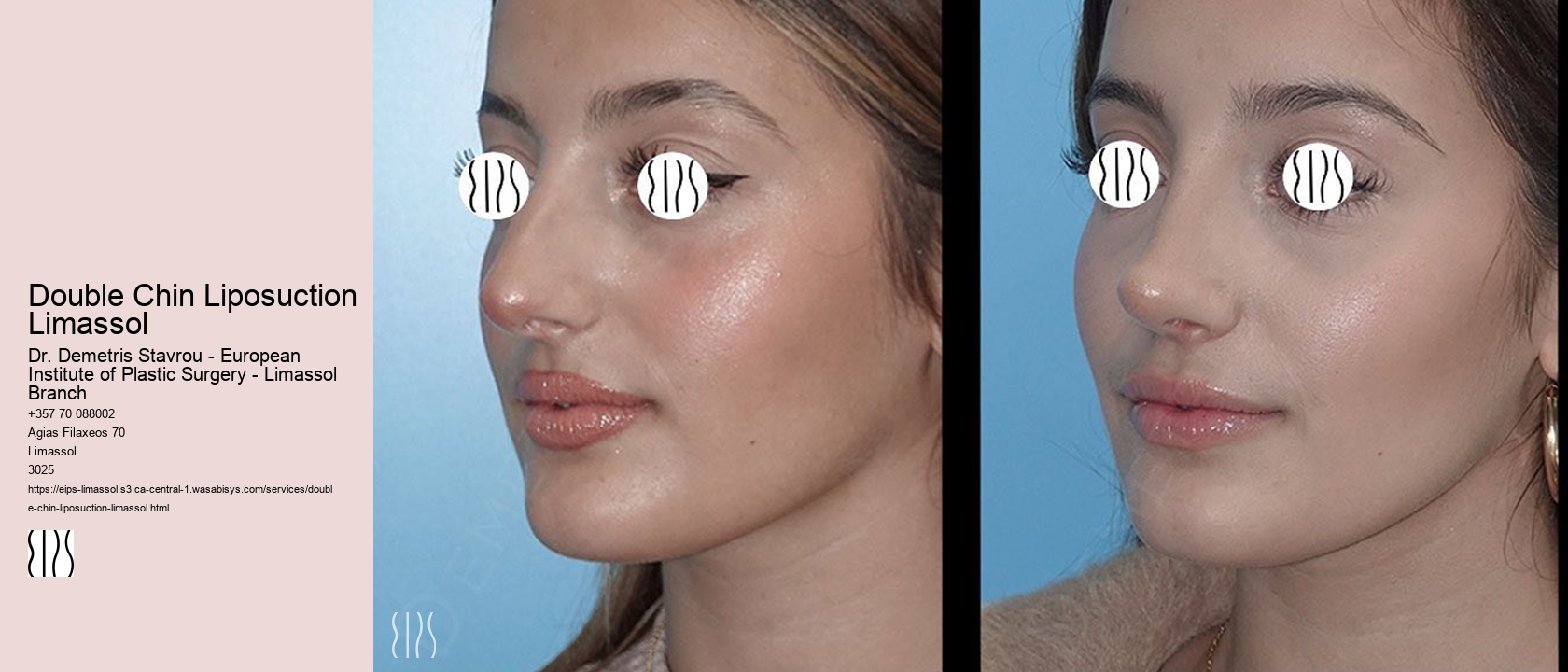 Double Chin Liposuction Limassol