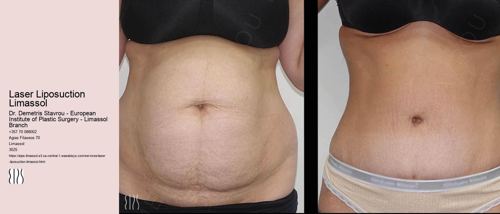 Laser Liposuction Limassol