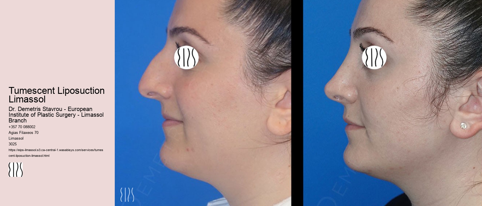 Tumescent Liposuction Limassol